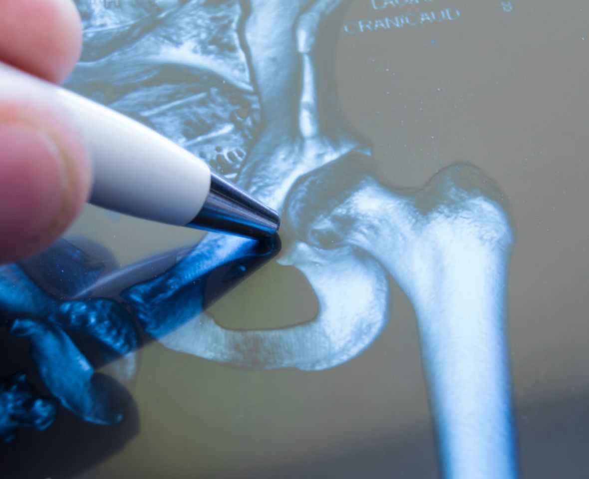 Medical illustration hip and pelvic bone