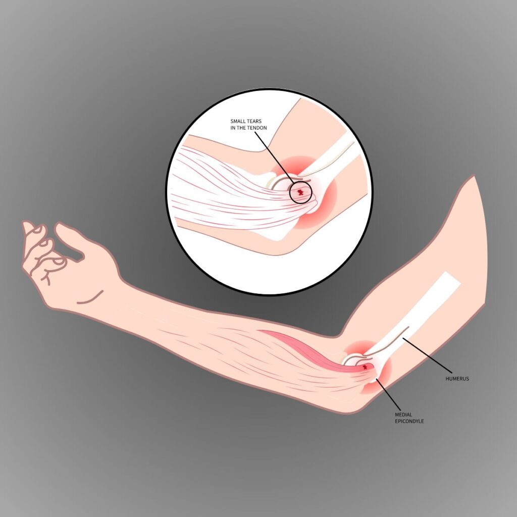 Medical Illustration: Golfer's Elbow