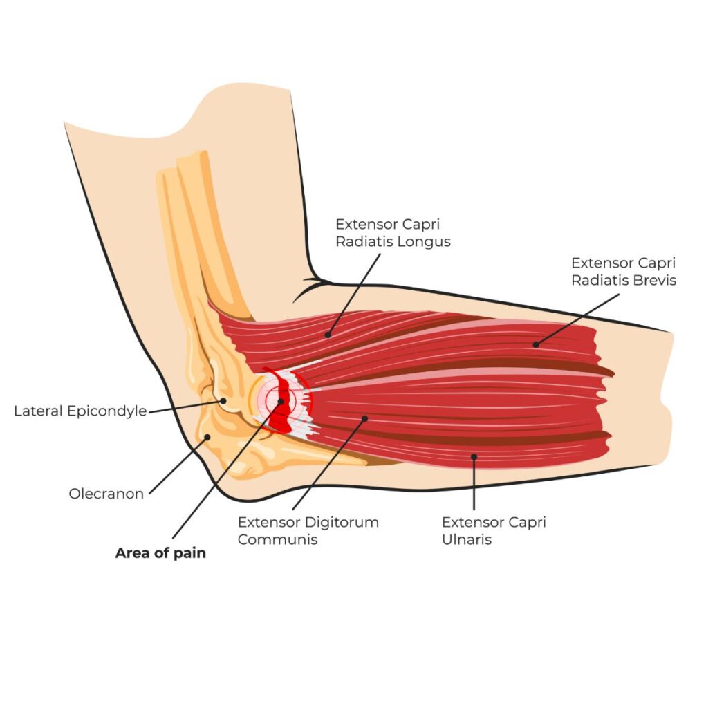 Medical Illustration: elbow