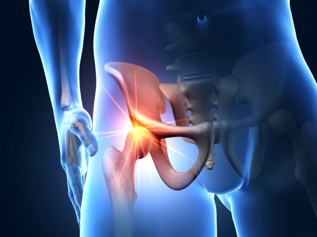 Medical illustration hip pain
