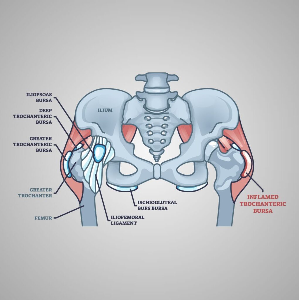 Medical Illustration Trochanteric