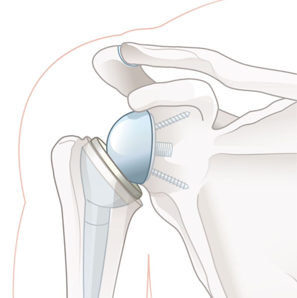 Medical Illustration Shoulder replacement