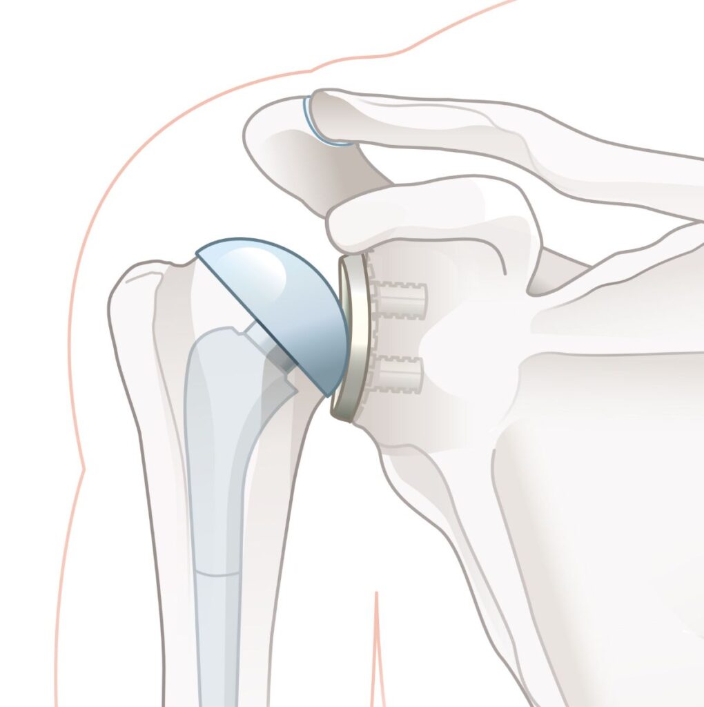 Medical Illustration Shoulder replacement