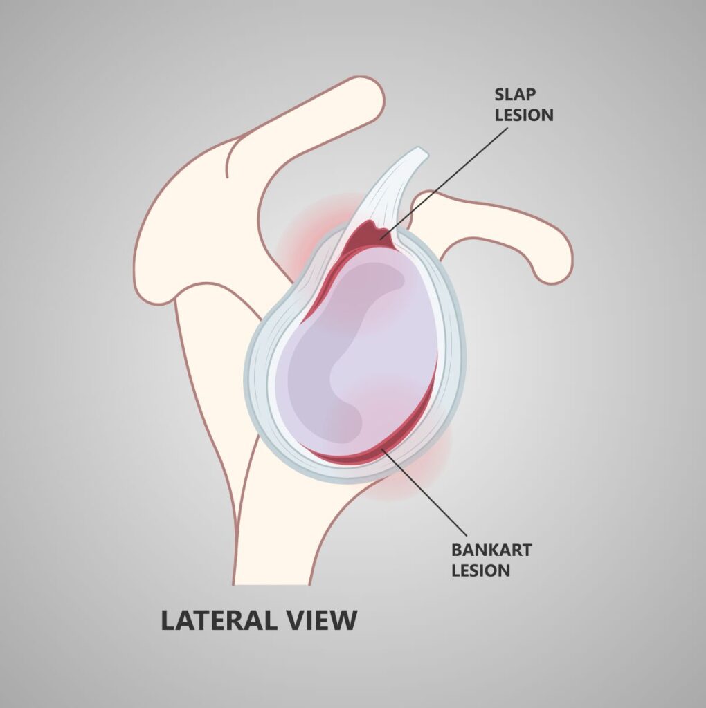 Medical Illustration Labrum