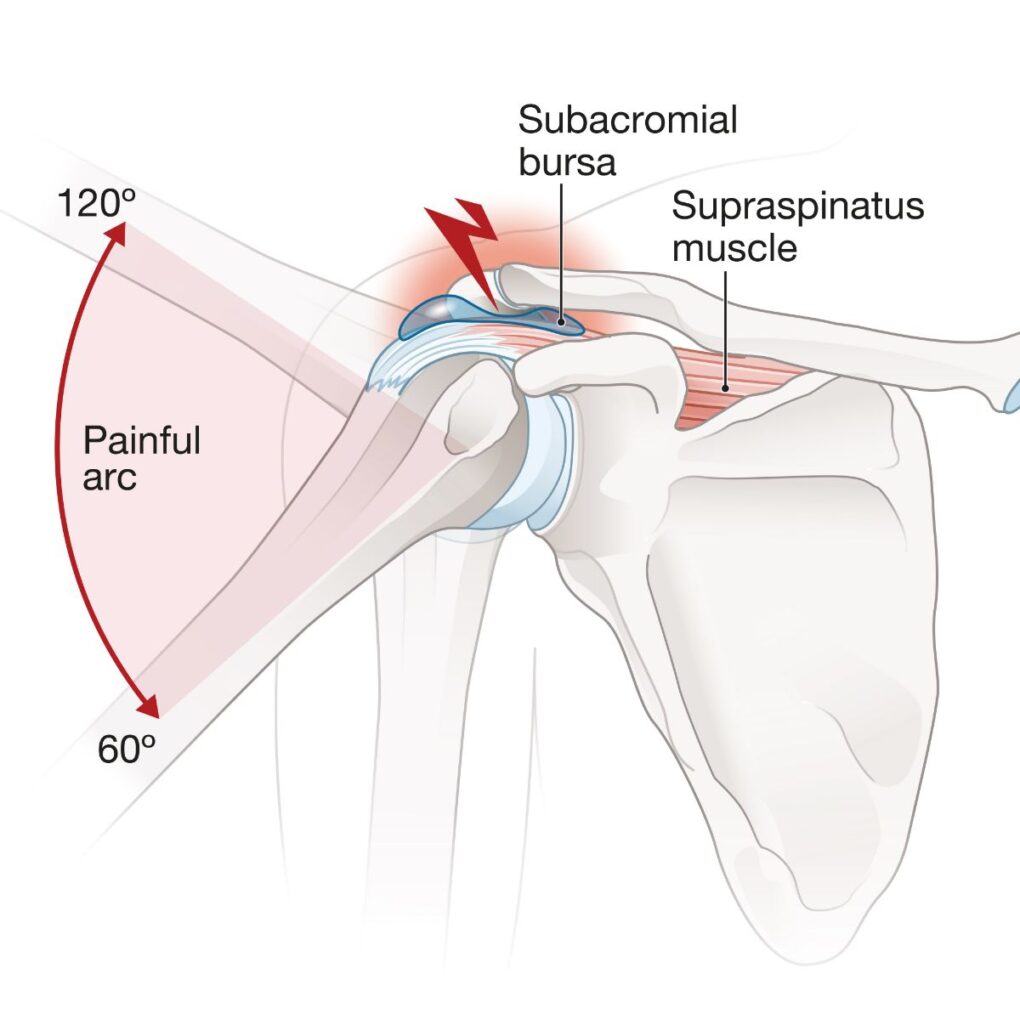 Medical Illustration Shoulder Impingement